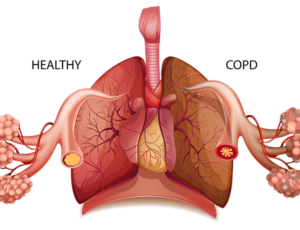 copd silca dust effects